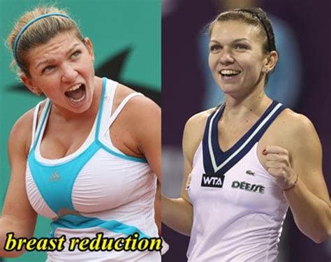 Teen tennis star Simona Halep had breast reduction surgery to。